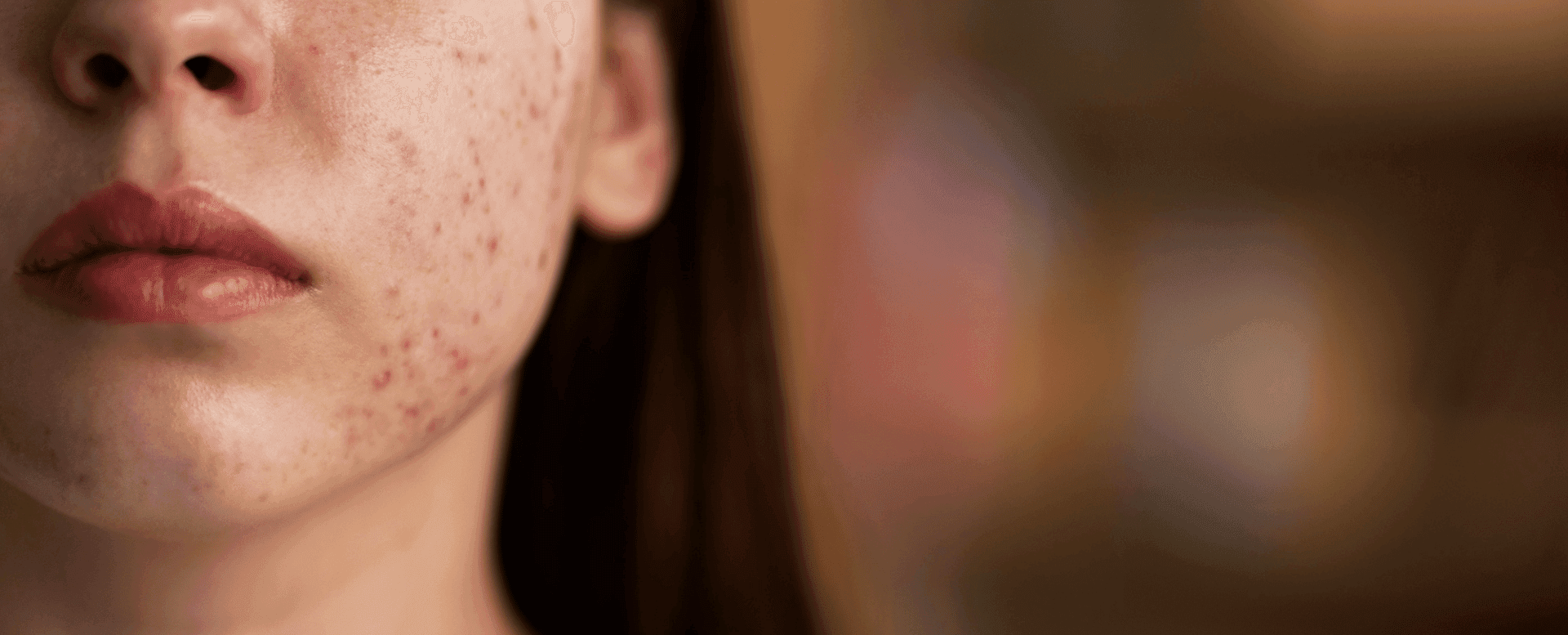 The Hidden Link Between Stress and Skin Problems